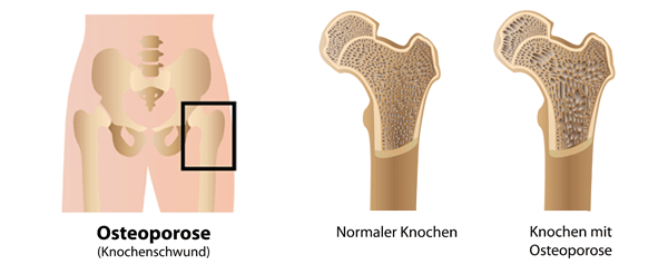 Bild eines gesunden und eines erkranten Knochen Ursachen der Osteoporose