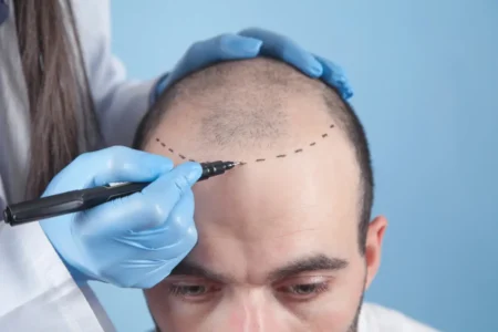 Haartransplantation: 3 Methoden und ihre Vorgehensweise vorgestellt