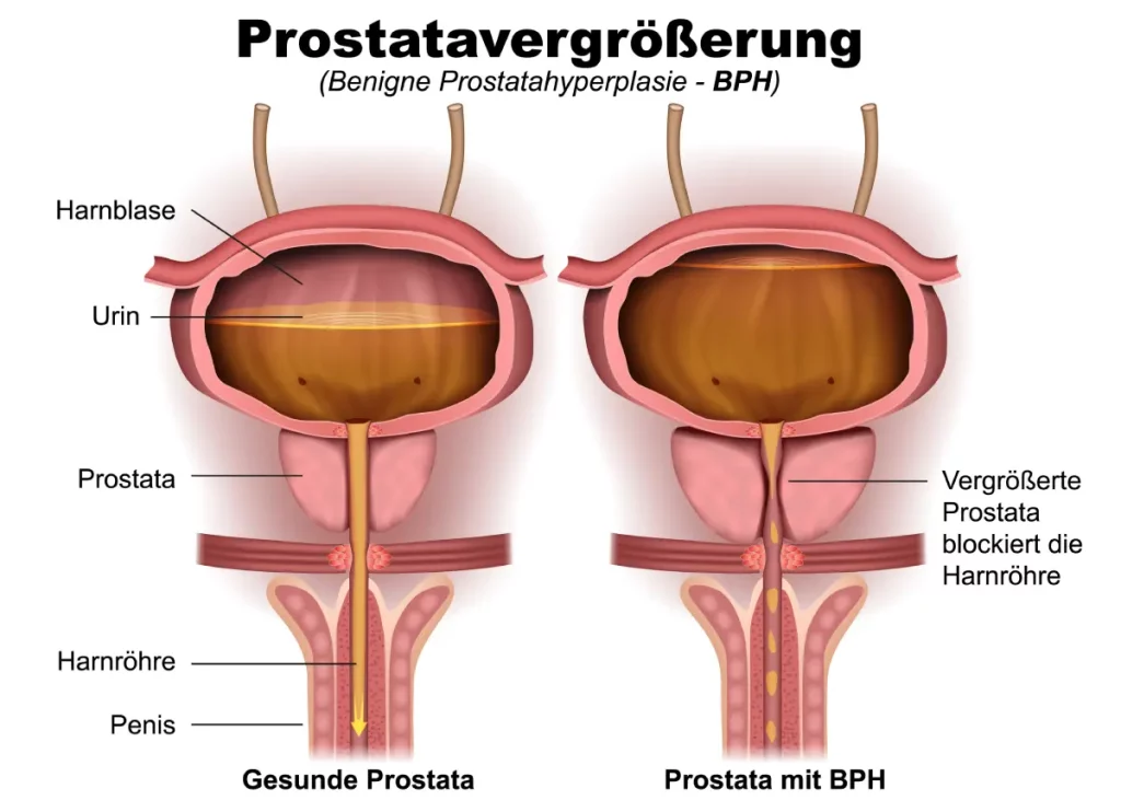 Grafische Darstellung einer Prostatavergrößerung Prostatavergrößerung: Anzeichen, Ursachen und was hilft